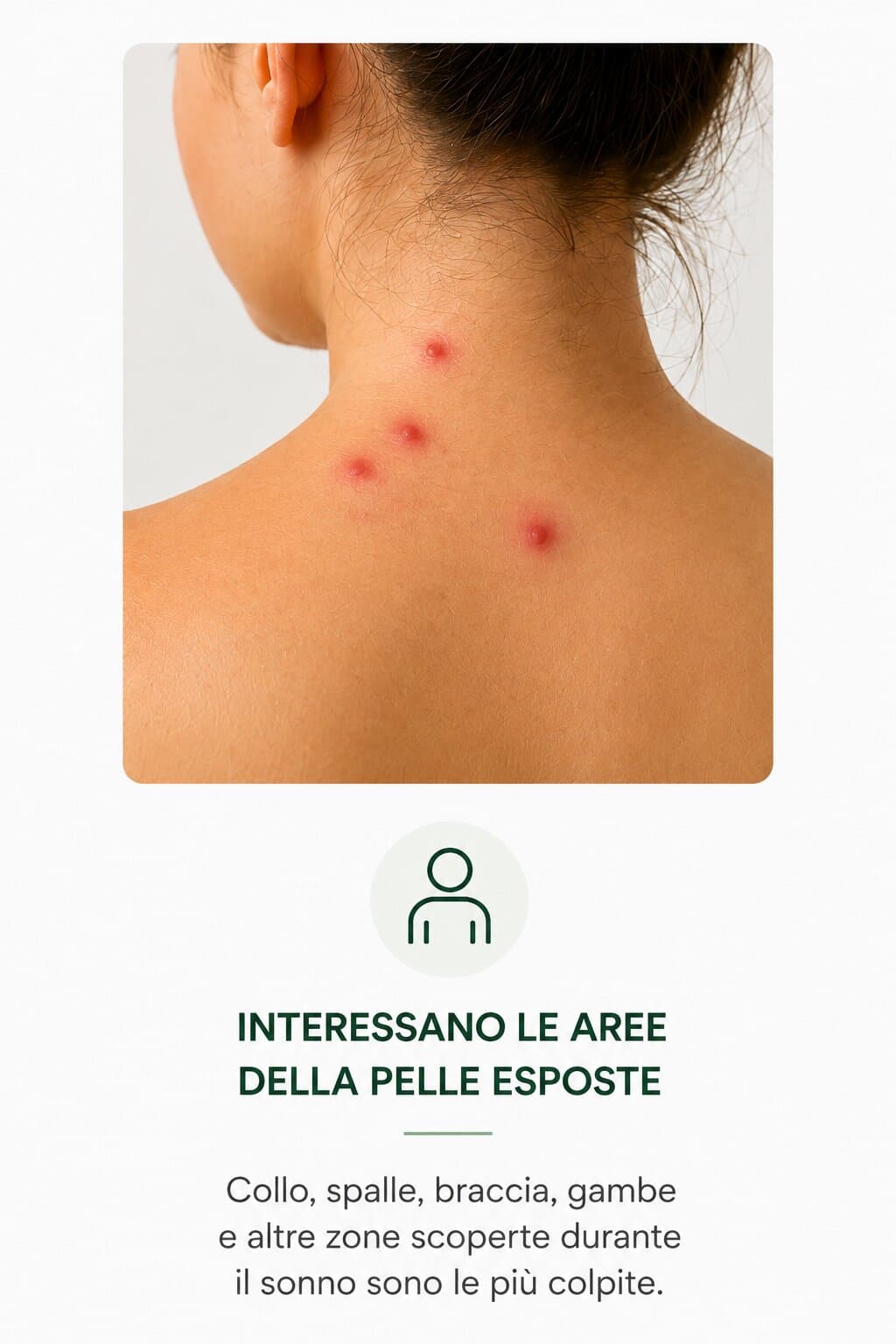 pelle esposta punture cimici Punture di cimici dei letti in fila sulla pelle