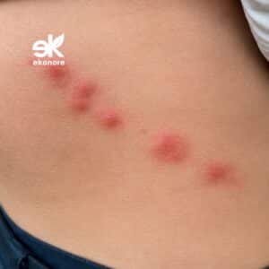 Punture di cimici dei letti sul fianco disposte in fila diagonale