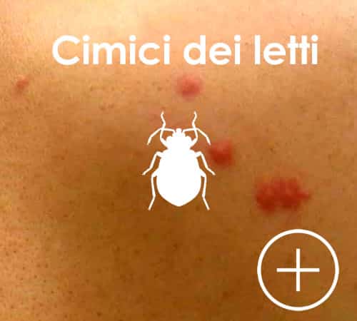 Reazione cutanea a punture di cimici dei letti