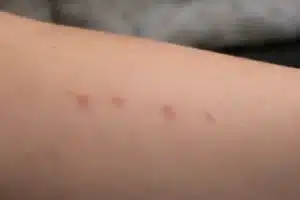 Punture di cimici dei letti allineate a fila sulla pelle, segno tipico di infestazione