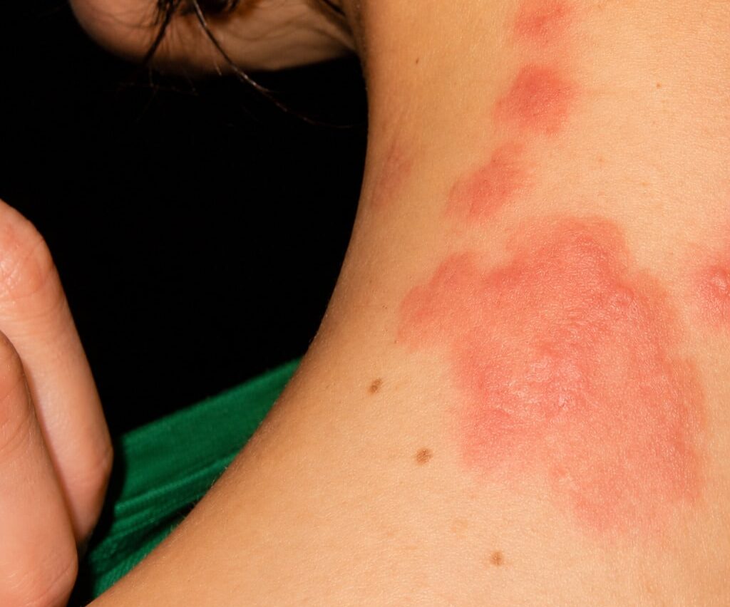 puntura scleroderma disinfestazione bio