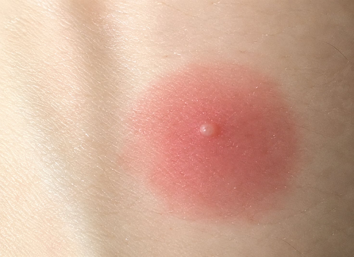 puntura scleroderma domesticus