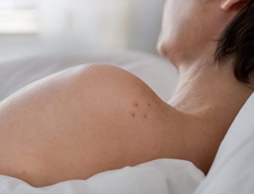 Cimici dei Letti in Gravidanza: Rischi e Rimedi Sicuri (2026)