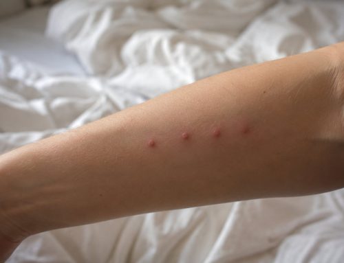 Ogni quanto pungono le cimici dei letti